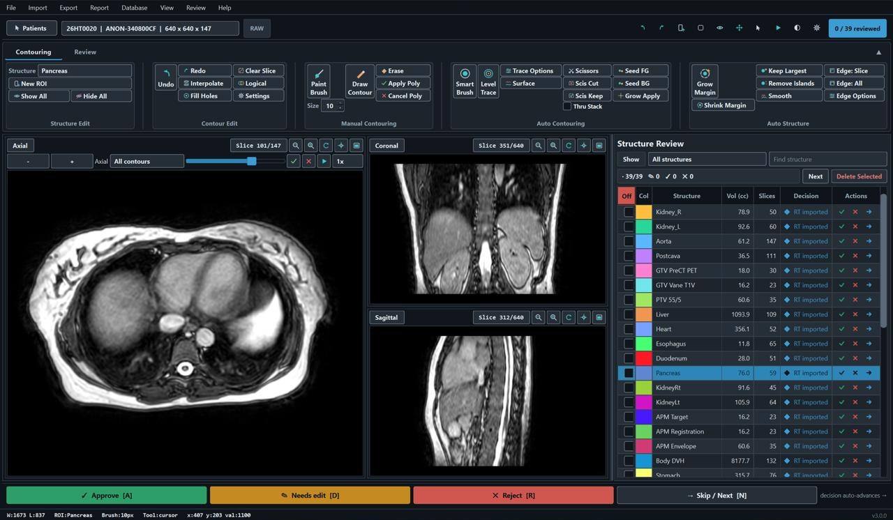 A radiotherapy planning workstation showing CT and MRI slices beside a structure-contouring panel.